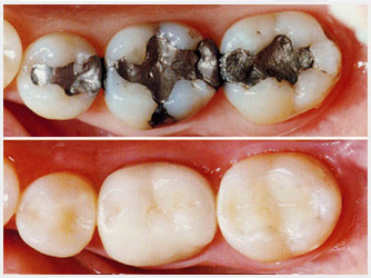 Tooth Fillings