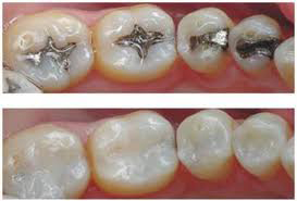 Silver-Gold Fillings